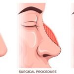Rhinoplasty in Sydney Sculpting Aesthetic and Confidence