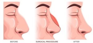 Rhinoplasty in Sydney Sculpting Aesthetic and Confidence