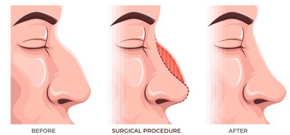 Rhinoplasty in Sydney Sculpting Aesthetic and Confidence